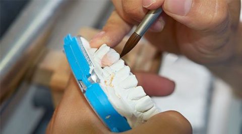 Inlays And Onlays Belmont WA Epsom Dental Care