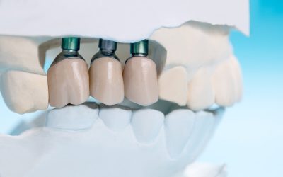 Pros and Cons of Crowns and Bridges: Is It the Right Choice for You?