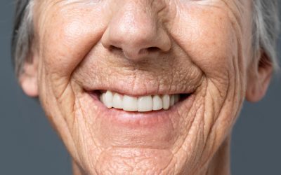 Which is Perfect for You: All-on-4 or Traditional Dental Implants?